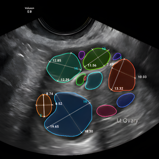 FOLLISCAN: Increase IVF throughput and accuracy with AI-assisted ultrasound analysis