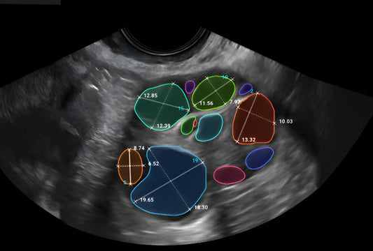 FOLLISCAN: Increase IVF throughput and accuracy with AI-assisted ultrasound analysis